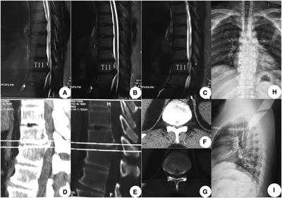 A modified percutaneous transforaminal endoscopic surgery for central calcified thoracic disc herniation at the T11/T12 level using foraminoplasty and decompression: A case report